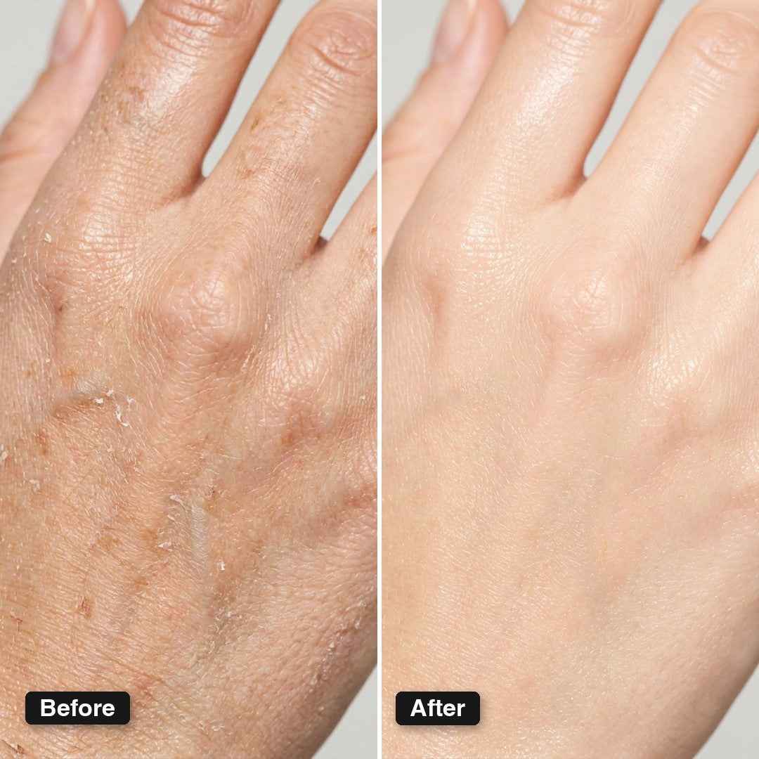 Before and after — flaky, rough hands turned smooth