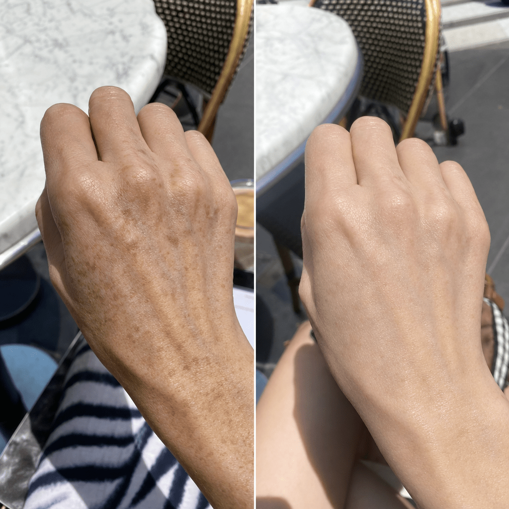 Before and after — hand dark spots faded, brighter even tone